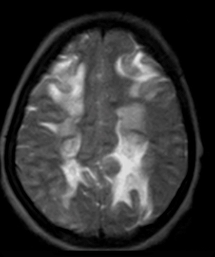 Figure 2 MRI of head showing axial T2WI subcortical and deep white matter T2 hyper densities in the parasagittal region.