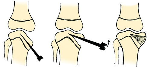 Figure 1 c. Operative technique. The chiseling is done proximal to the epiphyseal line and proceeds to the midline (left). The fragment is slowly elevated, lifting the whole fragment in one piece (middle). Solid bone grafts from the iliac crest, large enough to force the fragment into maximal elevation, are wedged under the fragment under maximal forced valgus of the knee (right).