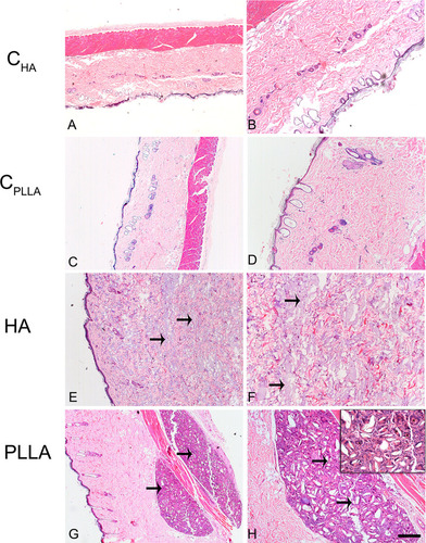 Figure 4 Photomicrograph of dermal skin biopsies after 60 days of dermal injection of PBS (control for HA: A and B), distilled water (control for PLLA: C and D), HA (E and F), and PLLA (G and H). Arrows indicate the presence of dermal filler. The asterisks show multinucleated giant cells (inset). Scale: (A, C, E and G)= 500 μm; (B, D, F and H)= 200 μm. Inset= 20 μm.