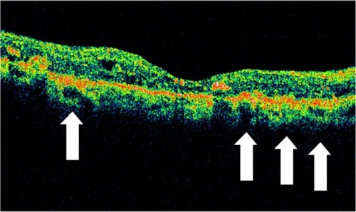 Figure 30 Stratus optical coherence tomography image.