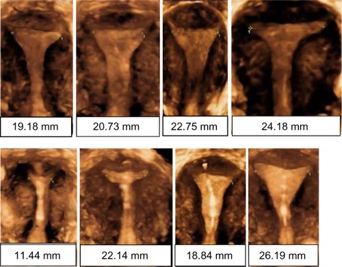 Figure 3 3D ultrasound in nulliparous women.
