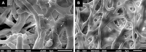 Figure 1 Scanning electron microscopy demonstrating mature fungal biofilms that were formed in 24-well plates. White arrows depict extracellular matrix covering and connecting the hyphae. (A) Trichophyton rubrum ATCC 28189. (B) Trichophyton mentagrophytes ATCC 11481. Reprinted from J Am Acad Dermatol, 1;80(4), Lipner SR, Scher RK, Onychomycosis: Clinical overview and diagnosis, 835–851, Copyright (2019), with permission from Elsevier.Citation4