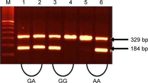 Figure 1 Amplification of TNF-α (−308G/A) alleles (G and A).