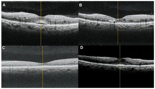 Figure 7 Radial OCT images of eye no.2 in group III ((A) At presentation, (B) 1 month after injection, (C) 3 months after injection, (D) 6 months after injection).