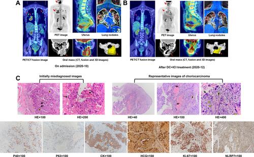 Figure 1 CC pathology and 18F-FDG PET/CT images. (A and B) Clinical responses of the patient to DC+ICI treatment: PR. (C) HE-stained section of the tumor showed extensive hemorrhage and necrosis at low magnification, the biphasic feature of mixed cytotrophoblasts (black triangle) and syncytiotrophoblasts (black arrow) and nuclear division in tumor cells (star) at high magnification. In some regions, tumors are mainly composed of mononuclear cytotrophoblasts, and syncytiotrophoblasts are few and inconspicuous, which is easy to be misdiagnosed as poor-differentiated carcinoma. Immunohistochemical markers provided further support for the diagnosis of CC.