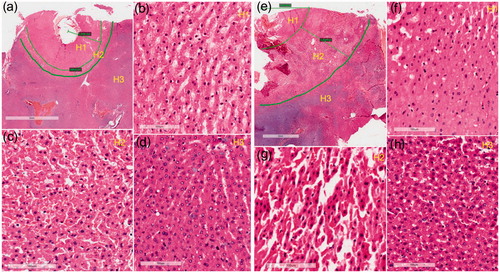 Figure 4. H&E stain images of in vivo tissue. (a) Overall view of the ablated tissue treated by RF heating only. Three distinct zones are identified; (b–d) the enlarged view of zone H1/H2/H3 from (a); (e) overall view of the ablated area treated by RF heating with pre-freezing with the zones specified; (f–h) the enlarged view of zone H1/H2/H3 from (e). The center of the ablation area is the necrosis coagulation zone (H1). The middle zone (H2) is the transition zone, with interstitial infiltration of red blood cells. The outermost zone (H3) is the normal tissue.