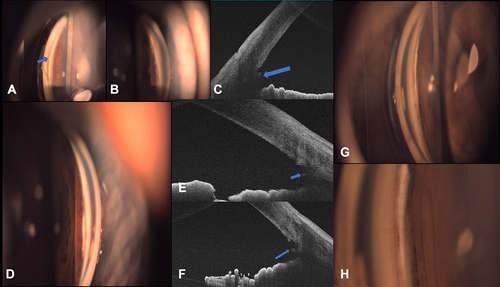 Figure 1 A-H shows the trabecular leaflet (Arrows) with open shelf on gonioscopy ((A and B) Patient 1, (D) Patient 2, (G and H) Patient 3) and anterior segment optical coherence tomography ((C, E and F), respectively).