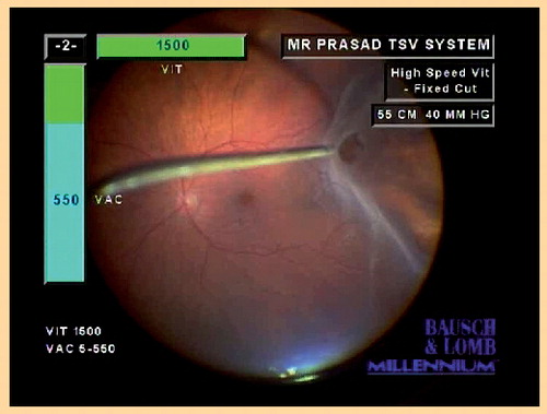 Figure 2. A chandelier light permits bimanual surgery since the surgeon’s hand, which would otherwise hold the light pipe, is now free.Here the right hand is being used to indent while the left hand controls the ocutome.Provided courtesy of S Prasad (Consultant Ophthalmic Surgeon, Wirral University Hospitals, UK).