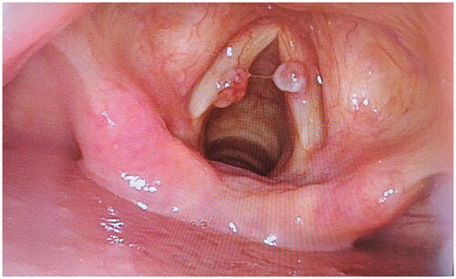 Figure 1. Vocal cord polyp located at the anterior third junction of the vocal cord before treatment.