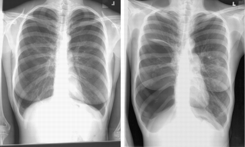 Figure 1. PA chest radiograph at presentation (left) and then 2 years later (right). Both radiographs demonstrate typical changes associated with emphysema, including hyperinflation, flattening of the diaphragm, and a paucity of pulmonary vascular markings peripherally. Note the rapid development of large bullous disease on the right.