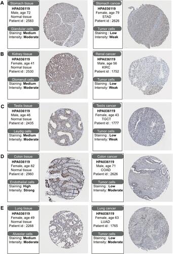 Figure 2 Differential expression of protein levels of CHMP7 in the HPA database. (A) CHMP7 was moderately expressed in normal gastric tissues and lowly expressed in STAD tissues; (B) CHMP7 was moderately expressed in normal kidney tissues and lowly expressed in KIRC tissues; (C) CHMP7 was moderately expressed in normal testicular tissues and lowly expressed in TGCT tissues; (D) CHMP7 was highly expressed in normal colon tissues and lowly expressed in COAD tissues; (E) CHMP7 was moderately expressed in normal lung tissues and lowly expressed in LUAD tissues.