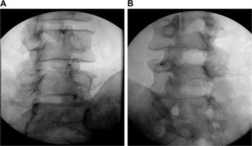 Figure 2 Facet joint interventions.