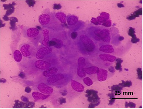 Figure 5 Hurthle cells (Giemsa, x400).
