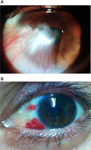 Figure 5 Pterygium case (A) preoperatively and (B) 2-weeks postoperatively.