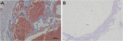 Figure 4 (A) a large number of vascular malformations around adipose tissue. (B) vacuolar adipose tissue.
