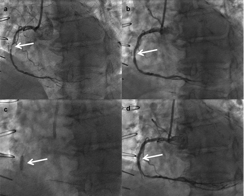 Figure 5. A = Severely calcified stenotic lesion in native RCA (white arrow). B = Under-expanded stent post PCI. C = IVL balloon inflated within underexpanded stent. D = Well expanded stent post IVL therapy.