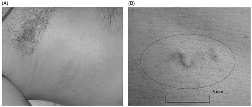 Figure 2. Photographs of Grade 1 skin toxicity following HIFU treatment for liver metastasis. (B) This is a magnified version of photo A, showing the lesion on a measured scale. This image is taken from Illing et al. 2005 (16).