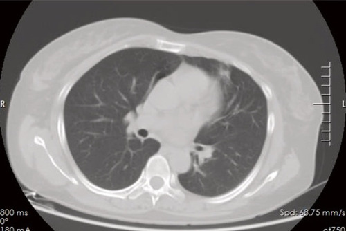 Figure 4 Computed tomography of the lung showed a few cords in the left upper lung.