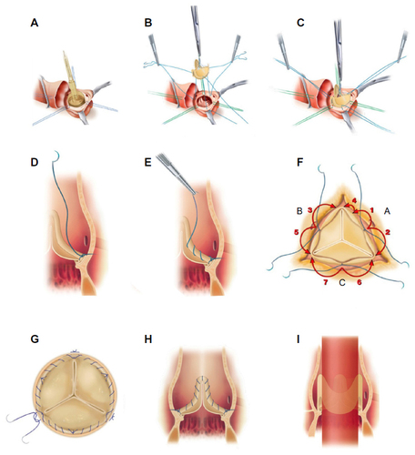 Figure 2 Implantation technique of the Freedom SOLO stentless valve.