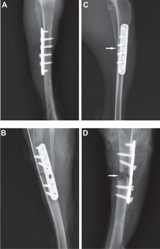 Figure 6 (A,B) Representative X-ray images after surgery. (C) Tibia with vancomycin-coated implant: new bone formation and slight soft-tissue swelling were observed. (D) Tibia without vancomycin-coated implant: osteolysis (white arrow) and serious soft-tissue swelling are clearly visible.