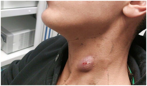 Figure 1. The patient’s neck mass, upon his admission to the otolaryngology/head and neck surgery department.