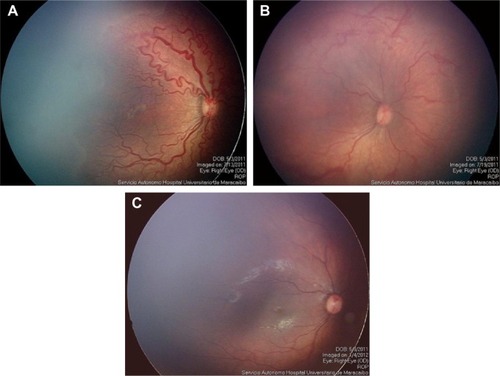 Figure 1 Image before IVR monotherapy (A); 6 days after IVR monotherapy (B); and after 6 months of IVR monotherapy (C).