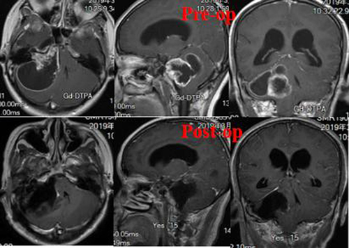 Figure 1 MRI imaging of case 1.