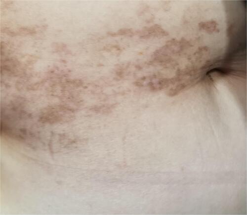 Figure 1 Herpes zoster in a right-sided T10-12 dermatomal distribution. The vesicular crusts has fallen off leaving temporary pigmentation.