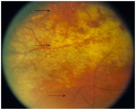 Figure 2 Retinitis is progressing from top to bottom: solid line points to area of necrotic retina following retinitis; dashed line points to area of active retinitis; dotted line points to area of normal retina.