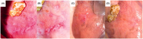 Figure 11. Patient suffering oral erythoplakia: (A) before treatment, (B) after 3 weeks, (C) after 5 weeks and (D) after 6 weeks (treated with CurSLN-gel).