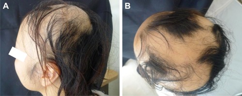 Figure 2 Therapeutic effect of a 23-year-old woman with refractory alopecia areata.