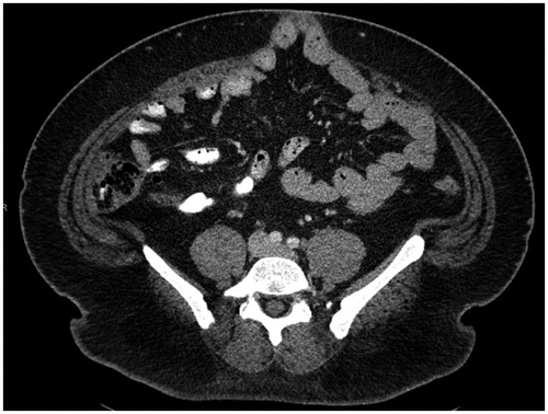 Figure 1. Incisional hernia defined as an abdominal wall defect with or without bulge in the area of a postoperative scar identified on CT imaging.