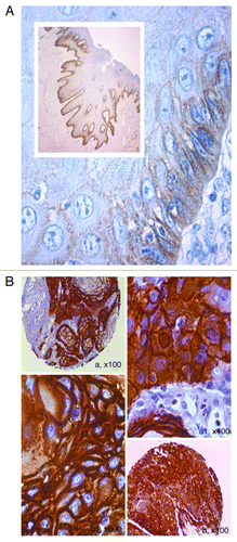 Figure 1. EGFR expression in normal peri-tumor oral epithelium as evaluated by immunohistochemistry and in representative cases of OSCC’swith amplified EGFR. (A) EGFR shows a high expression limited to the basal proliferative layer, whereas spinous epithelial layer demonstrated faint-intermediate expression at membrane malpighian bridges ( LSAB-HRP, original magnification x63, inset original magnification x100). (B) Photos A and B show two different cases with strong EGFR expression. Amplified cases showed very strong circumferential staining of the membrane that appeared remarkable thickened; in addition, cytoplasms were stained (A1 and B1) and in some fields (A1) the nuclei appeared positive (LSAB-HRP, nuclear counterstaining with haematoxylin; Ventana pre-diluted Ab not specific for activating phosphorylations).