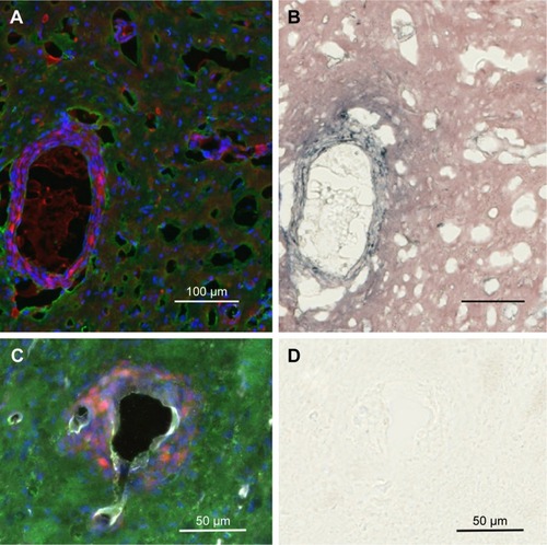 Figure 4 IV-injected AuNPs are associated with tumor cells lining blood vessels far from the main tumor mass.Notes: Region far from the central tumor: (A) fluorescence and (B) gold enhanced. Saline control far from the central tumor: (C) fluorescence and (D) gold enhanced. (A and C) mCherry red (tumor, red), anti-albumin (edema, green), DAPI (nuclei, blue), and anti-CD31 (blood vessels, white) and (B and D) gold enhanced (gold stained, black).Abbreviations: AuNPs, gold nanoparticles; CD31, cluster of differentiation 31; IV, intravenous.