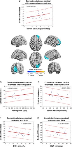 Figure 2 Cortical thickness–clinical correlation. There were four local peak vertices in right prefrontal cortex (white dots in the figure, 1, 2, 3, and 4 represent Peak 1, Peak 2, Peak 3, and Peak 4 separately). The correlations were performed between the cortical thickness in four peak vertices and clinical information across patients with ESRD. The correlations were considered significant at a threshold of P<0.05.
