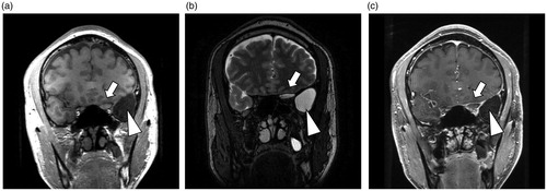 Figure 2. (a) T1-weighted, (b) T2-weighted and (c) Gd-enhanced coronal MRI images of paranasal sinus. MRI revealed a cystic lesion (arrow) around left anterior clinoid process which was adjacent to the left optic canal. There was an arachnoid cyst in the middle cranial fossa (arrowhead).