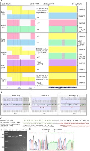 Figure 2. Results of genetic test. (A) Display of TGS sequences by Integrative Genomics Viewer (IGV). Each colored area represents one chromosome, but no correlations between HBA and HBB gene alleles. HBA2:c.427T > C is labeled with a black frame. The located positions are aligned to genome build hg38. (B) Results of MLPA of the father, mother and the proband. (C) Breakpoint sequences of NC_000016.10:g.170769_173000dupinsAAAAAA duplicate region. Reference sequences encompassing the breakpoints are shown above and below the sequence of the novel haplotype. The microrepetitive sequences are underlined. (D) Agarose gel electrophoresis results of the family numbers carried the novel haplotype. The PCR targeted the characteristic sequences of the X1/X2 fusion fragment. The sample with known αααanti4.2 was used as positive control (with X1/X2 fusion fragment) and WT was used as negative control (αα/αα). (E) Verification of the breakpoints for the novel haplotype by Sanger sequencing.