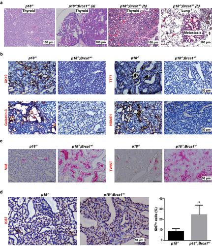 Figure 2. Heterozygous germline deletion of Brca1 in p18 null mice promotes EMT and enhances metastasis of thyroid tumors. (a) HE staining analysis of thyroid tumors developed in mutant mice. Note relative to p18−/− thyroid tumor cells, p18−/−;Brca1+/- cells are highly heterogenous and poorly differentiated. Tumor a and b show two thyroid tumors derived from two individual p18−/−;Brca1+/- mice. Picture in the most right shows lung metastasis from thyroid tumor b. (b, c) IHC analysis of thyroid tumors developed in mutant mice. Note relative to p18−/− tumor cells, more p18−/−;Brca1+/- cells expresses strong VIM and TWIST, but none or weak TTF1, CK19, Galectin-3, and HBME1. (d) IHC analysis of thyroid tumors with an antibody against Ki67. The percentages of Ki67-positive cells were calculated and plotted. Results represent the mean ± SD of three tumors per group.