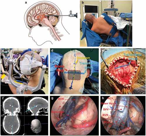 Figure 1. (a) Scheme of the introduction of the 0° endoscope toward the pineal region. Gravity provides retraction of the cerebellum inferiorly to allow the SCIT approach. (b and c) ‘Head-up’ Park-bench position. (d and e) Occipital midline skin incision and craniotomy. (f) Neuronavigation of the cadaver. (g and h) Cadaveric dissection demonstrating pivotal veins. BVR, basal vein of Rosenthal; CVC, central vein of cerebellar vermis; PCA, posterior cerebral artery; SVV, superior vermian vein.