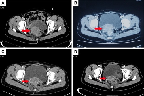 Figure 2 Pelvic CT shows the metastatic mass in front of the rectum. (A) Before therapy (August 17, 2015). (B) Before therapy (October 22, 2015), the mass was bigger than 2 months earlier (C) After 3 months of apatinib treatment (March 7, 2016), the mass was smaller than 4 months earlier. (D) After 9 months of apatinib treatment (August 30, 2016), the mass was smaller than 5 months earlier. Red arrows indicate the metastatic mass in front of the rectum.