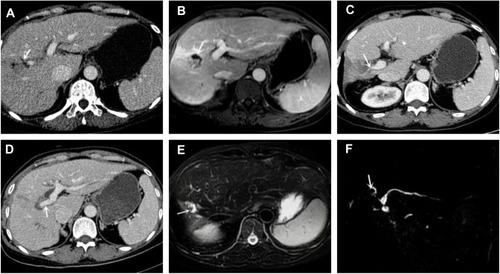 Figure 5 Female, 59 years old, after resection of right liver tumors, pathology diagnosis HCC (the 17th patient). (A) Four months after preventive TACE operation, upper abdominal enhanced-CT appeared right intrahepatic bile ducts mild dilation (arrow) along the portal vein. (B) Ten months after TACE, contrast enhanced MRI-T1WI showed right intrahepatic bile duct irregularly low signal, and the surrounding of dilated bile ducts appeared mild enhancement (arrow), which considered as cholangitis. (C and D) Follow-up enhanced-CT showed the right branch of portal vein line-like narrowing (arrow) and right hepatic atrophy obviously compared to pre-TACE (arrow). (E and F) Follow-up MRCP showed T2WI visible inhomogeneous high signal (arrow), and right intrahepatic bile ducts appeared filling defects, which was deemed as intrahepatic bile duct stones (arrow).