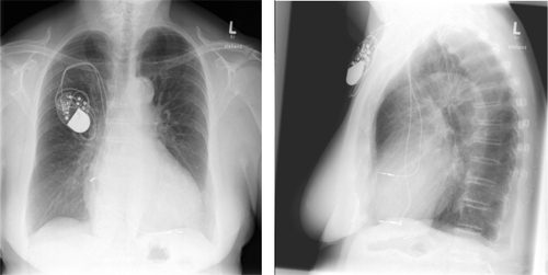 Figure 2 A) Three-month follow-up chest X-ray; B) three-month follow-up lateral chest X-ray suspicious of dislocation.