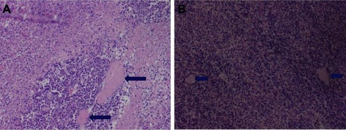 Figure 16 HE staining of the tumor (A is the control group, the long arrows point to muscle infiltration, B is the treatment group, the short arrows point to the ischemic necrosis, ×200).