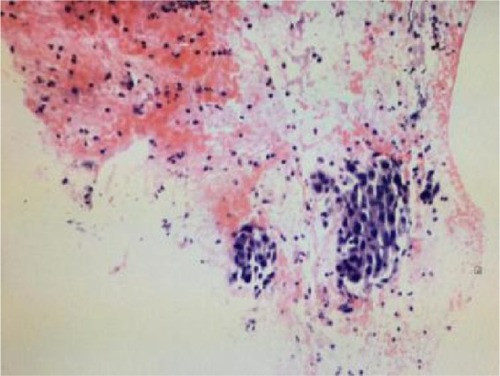 Figure 1 Tumor section staining with hematoxylin and eosin (400×).