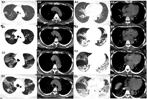 Figure 1. Evolution of the pure ground-glass opacities (GGO) on chest CT of patients with COVID-19. A 58-year-old woman who had close contact with individuals in Wuhan presented with fever for 2 days. (A1–A4) The first non-contrast-enhanced chest CT reveals multipleground-glass opacities in the right upper, middle, and lower lobes (initial chest CT). (B1–B4) Follow-up chest CT 4 days after the first shows that both the scope and density of the lesions increase (stage I*). (C1–C4) Follow-up chest CT 8 days after the first shows that the scope of the lesions increases while the density decreases (stage II*). (D1–D4) Follow-up chest CT 13 days after the first shows that the scope of the lesions decreases slightly while the density increases (stage III*). *The stage does not represent the course of COVID-19 but the time interval between the two adjacent CT scans.