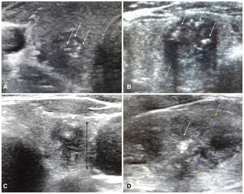 Figure 2 Suspicious ultrasound imaging features of TNs assigned to the AUS/FLUS category in UG-FNAB examination. (A) Transverse US imaging of a TN with microcalcifications (white arrows) without posterior acoustic shadowing. Histopathology revealed PTC. (B) Transverse US imaging of a TN with irregular margins (yellow arrows), microcalcifications (white arrows) and marked hypoechogenicity (blue arrows). Histopathology revealed fvPTC. (C) Transverse US imaging of a TN demonstrating a taller-than-wide shape (brackets). Hypoechogenicity is also presented. Histology revealed PTC. (D) Sagittal US imaging of TN with irregular margins (yellow arrows), microcalcifications (white arrows), cystic components (blue arrows) and hypoechogenicity. Histopathology revealed PTC. AUS/FLUS: atypia of undetermined significance/follicular lesion of undetermined significance; UG-FNAB: ultrasound guided fine needle aspiration biopsy; US: ultrasonography; TN: thyroid nodule; PTC: papillary thyroid cancer; fvPTC: follicular variant of papillary thyroid cancer.