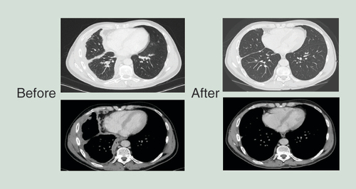 Figure 2.  Computed tomography scans from patient 5 before (left) and after 8 weeks (right) of TargomiR treatment, showing a partial response.Reprinted with permission from [Citation39] © American Thoracic Society (2016).