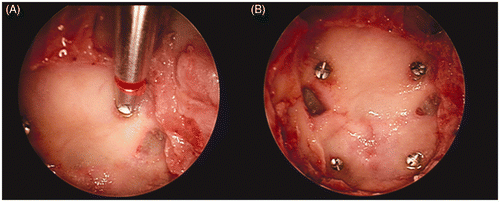 Figure 2. (a) Endoscopic view showing one of the internal targets being placed using endoscope guidance. (b) Endoscopic view showing the final location of the implanted internal targets (the planum and clivus).