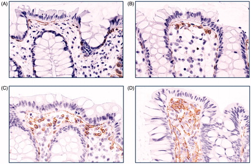 Figure 2. Grading of colonic mononuclear cell TF staining. Photos of immunohistochemistry for colon biopsies stained with tissue factor (TF) antibody representative for (A) grade 0, (B) grade 1, (C) grade 2, and (D) grade 3 staining of mononuclear cells. Original magnification 400×. Brown colour represents positive staining.