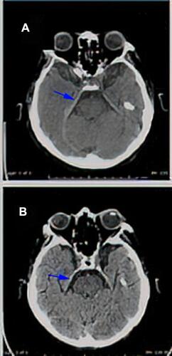 Figure 5 (A) Axial CT scan of the brain without IV contrast (patient cannot do MRI and cannot receive IV contrast because of rising creatine), this limited study shows thickening of the right tentorium in comparison to left one suggesting meningeal involvement (arrow in A). (B) Axial CT scan of the brain without IV contrast (patient cannot do MRI and cannot receive IV contrast because of rising creatinine), shows almost complete clearance of the thickened right tentorial leaflet (arrow in B).